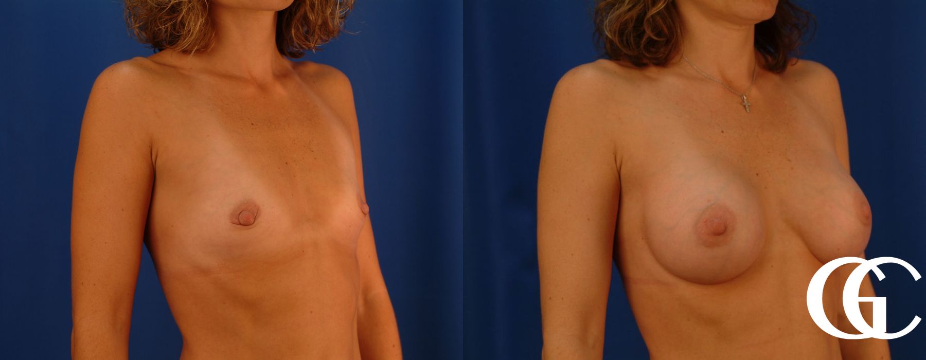 Breast Augmentation - Thumbnail 3