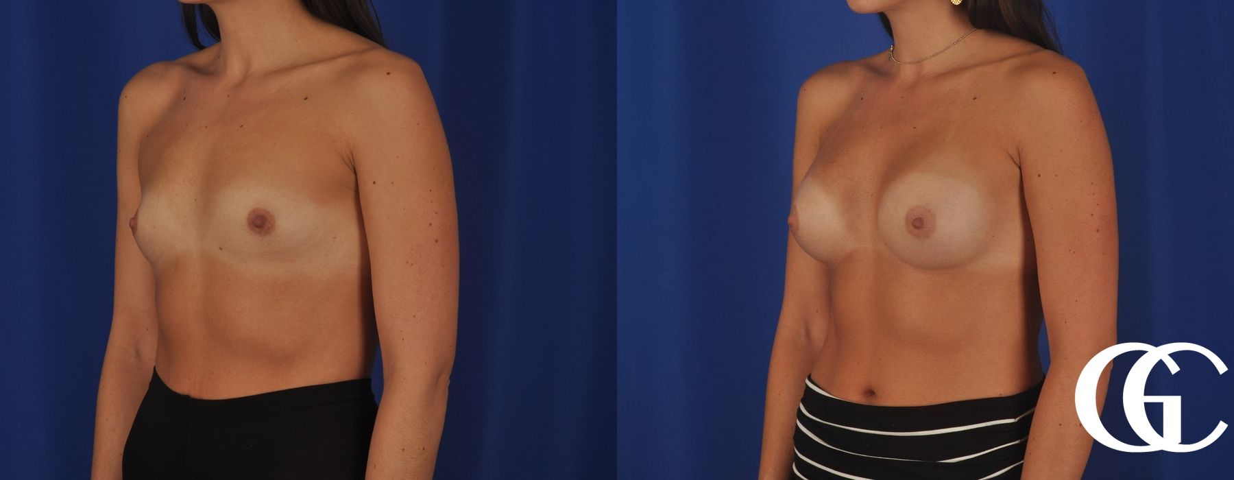 Breast Augmentation - Thumbnail 4