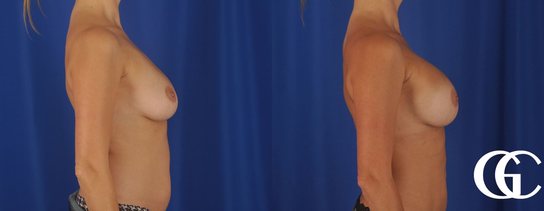 Breast Augmentation - Thumbnail 3