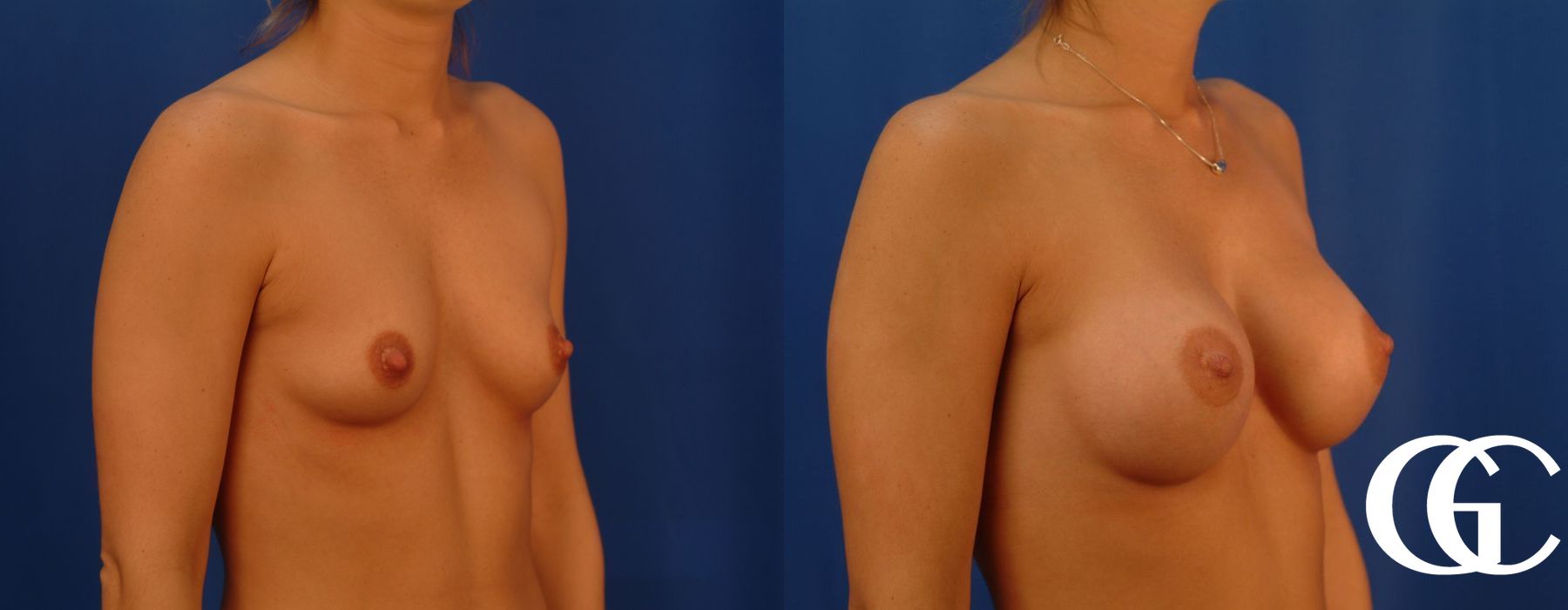 Breast Augmentation - Case 7217