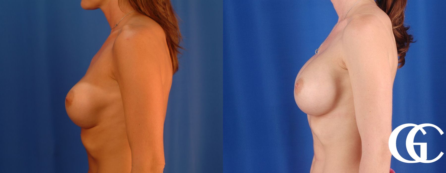 Breast Augmentation - Case 7105