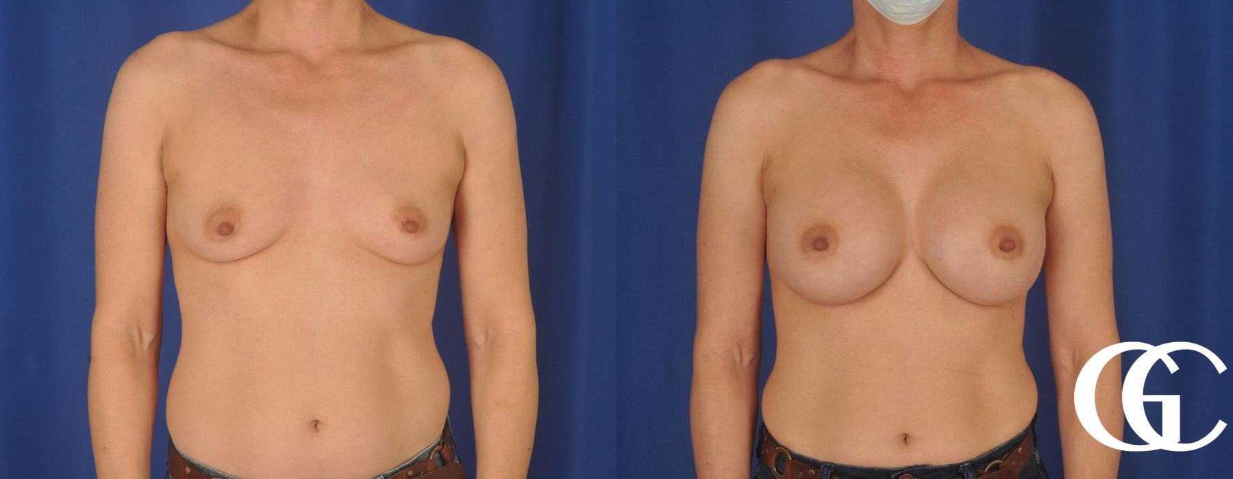 Breast Augmentation - Thumbnail 3