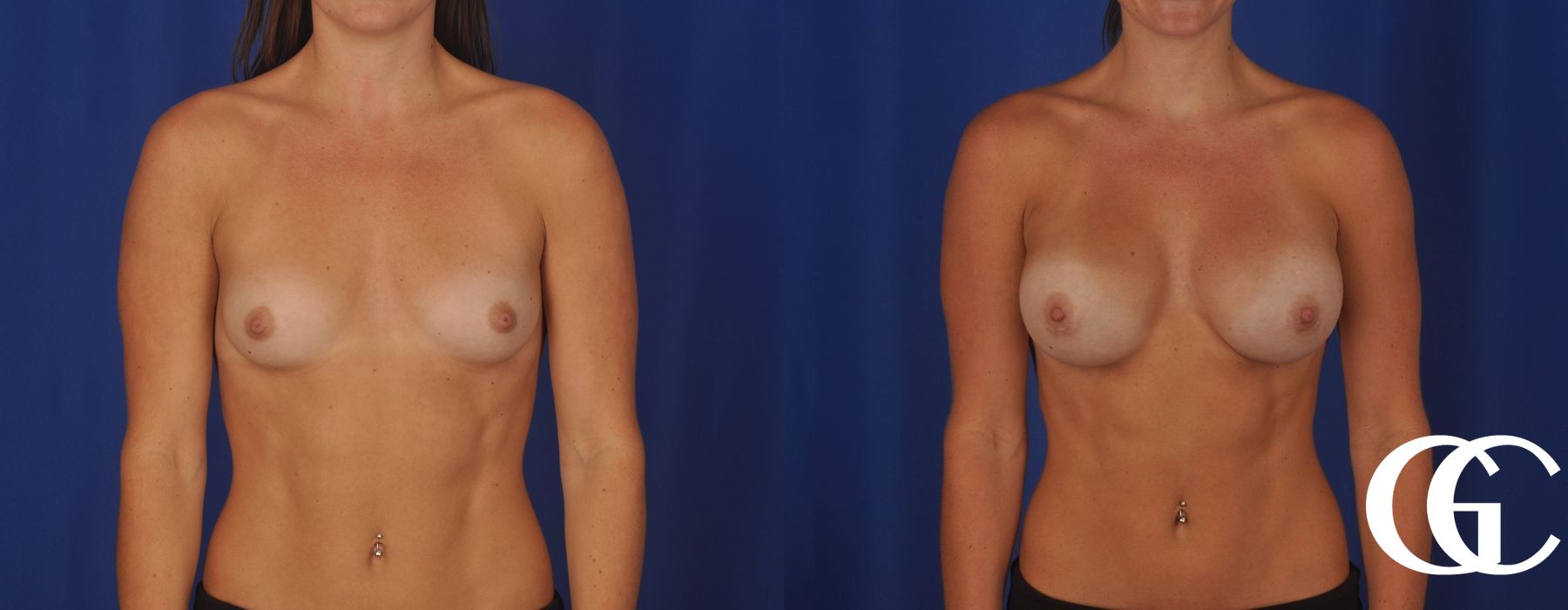 Breast Augmentation - Thumbnail 2