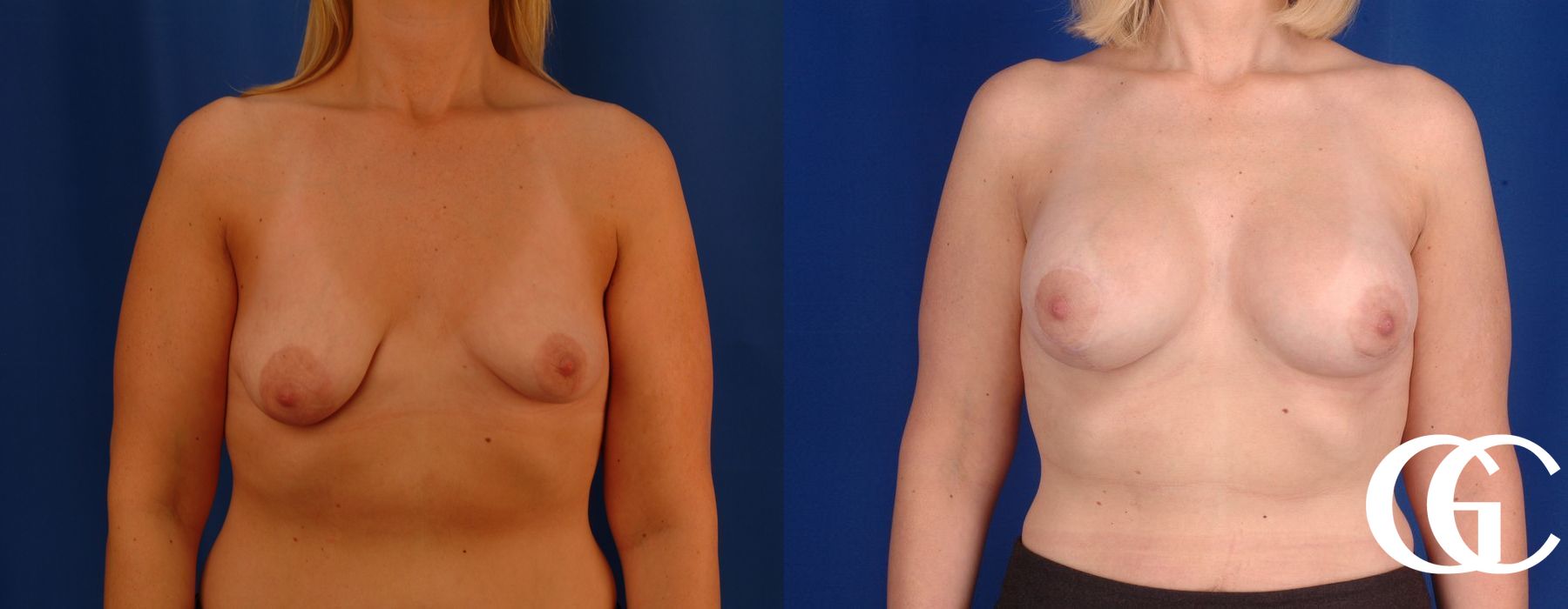 Breast Augmentation - Thumbnail 2
