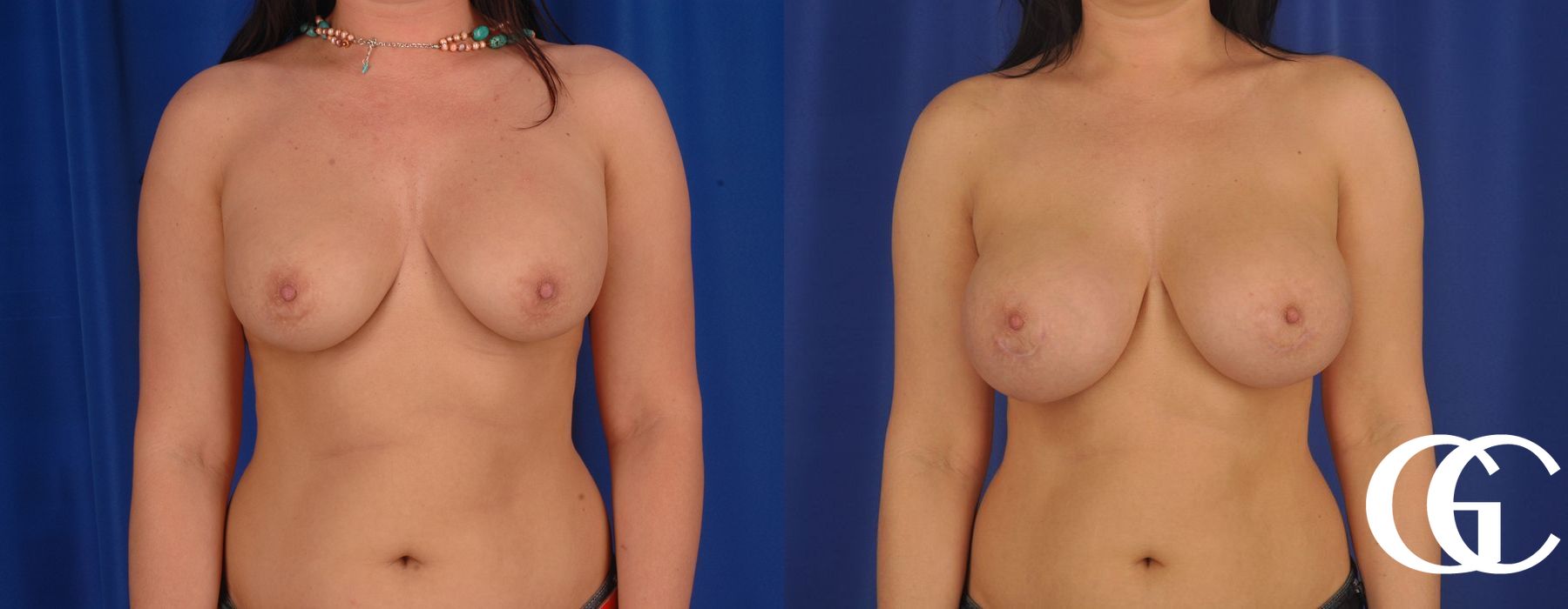 Breast Augmentation - Thumbnail 2