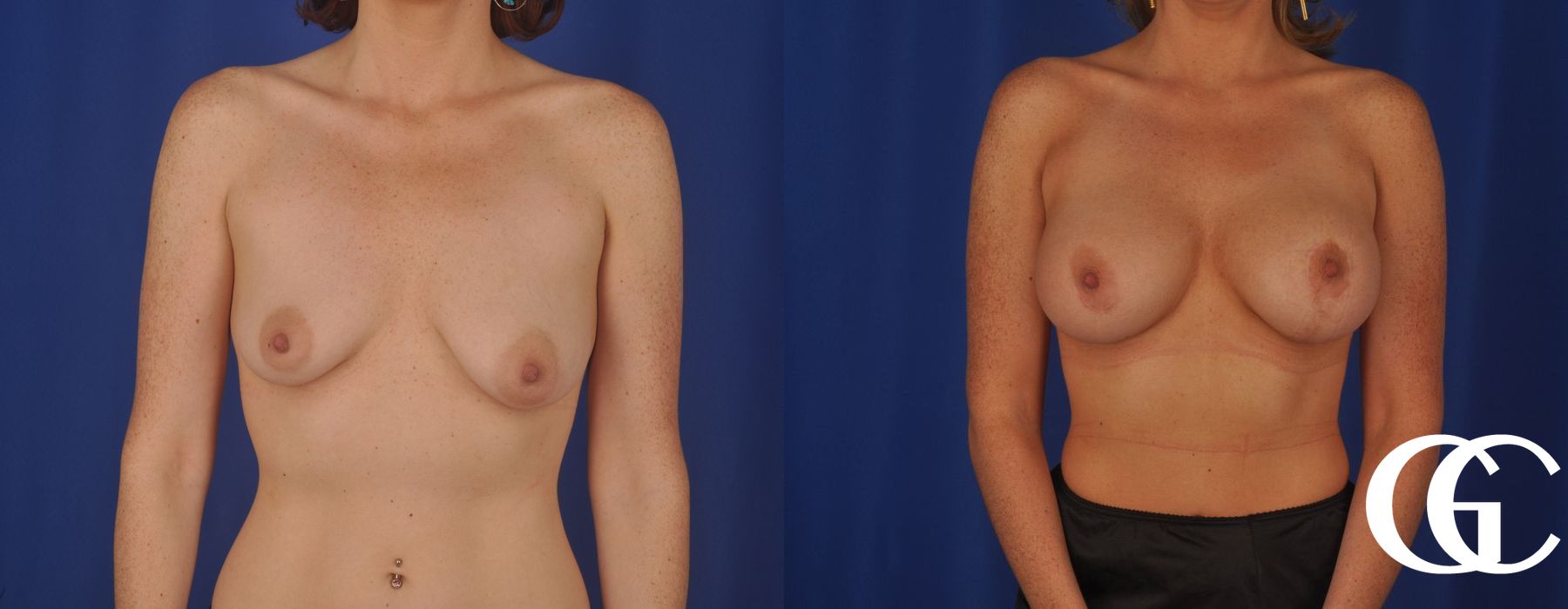 Breast Augmentation - Case 7073