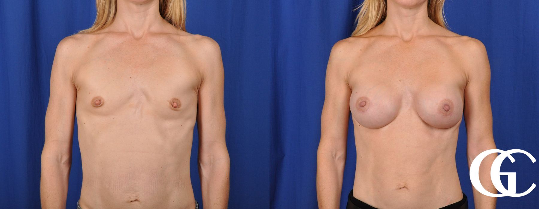 Breast Augmentation - Thumbnail 2