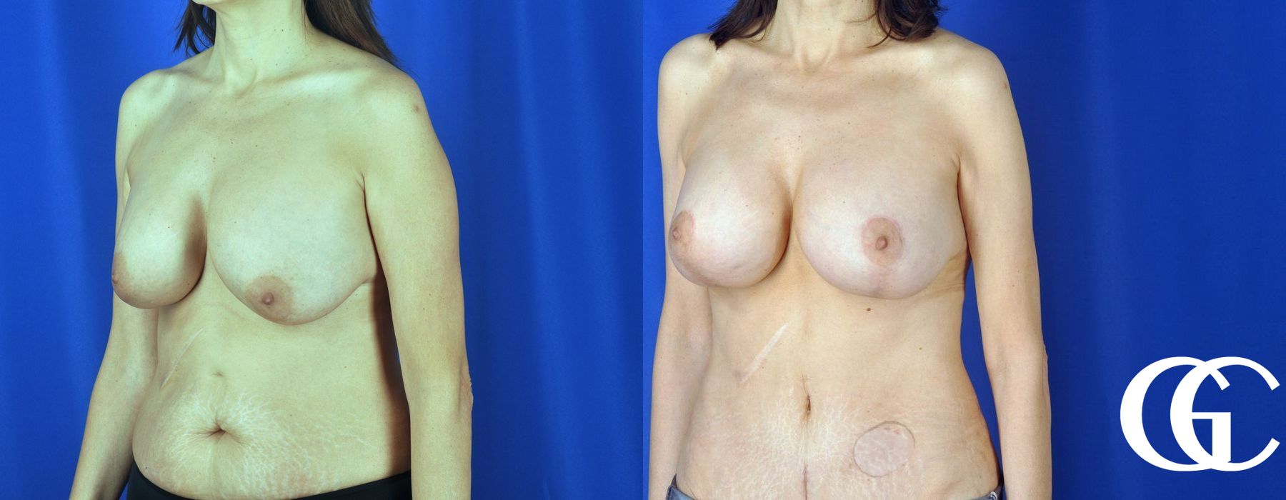 Breast Augmentation - Case 7040