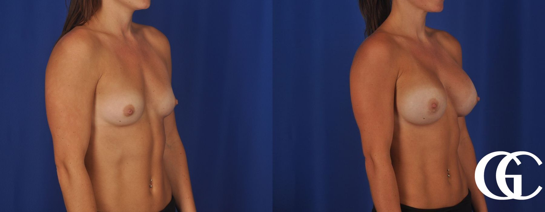 Breast Augmentation - Case 7071