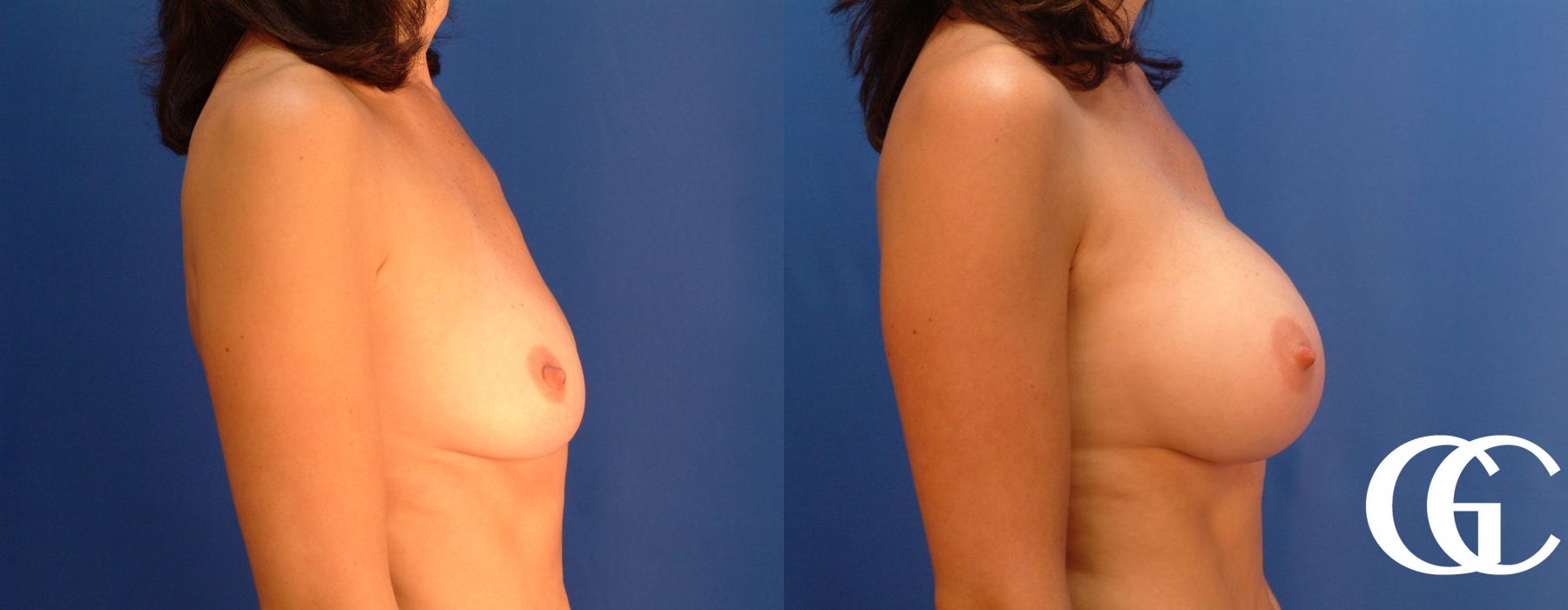 Breast Augmentation - Case 7086