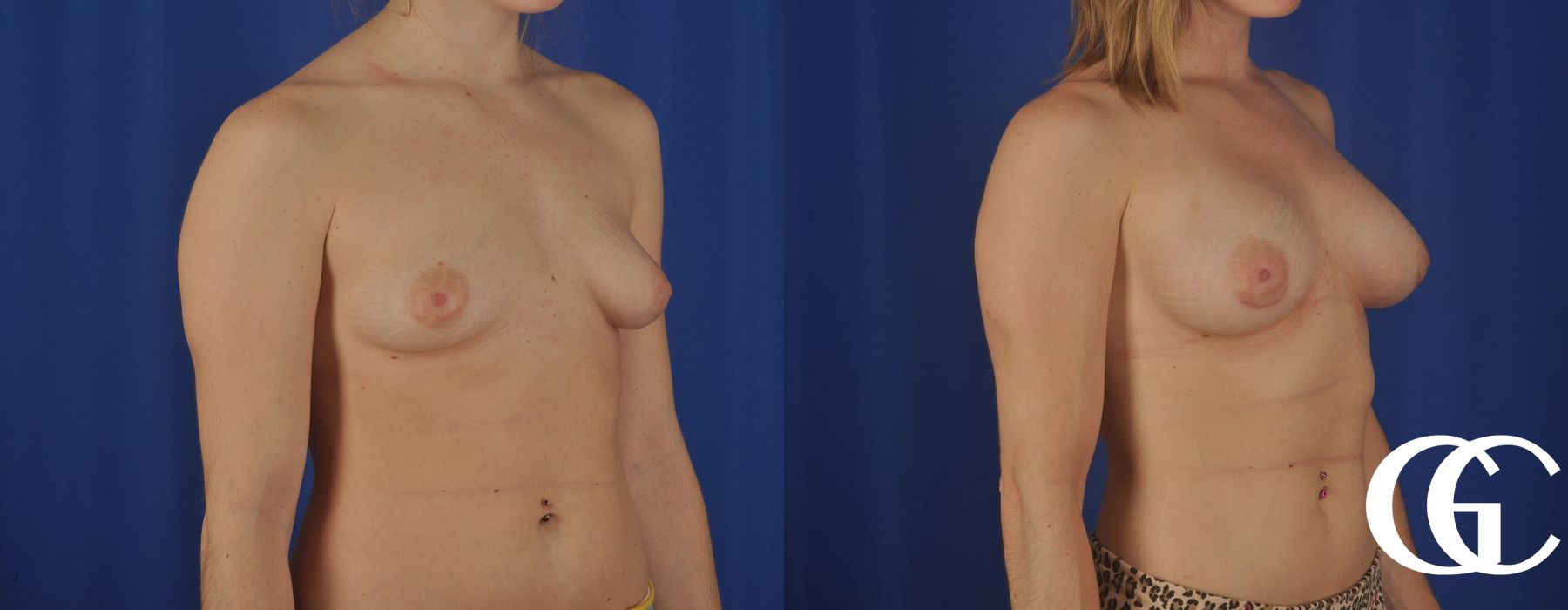 Breast Augmentation - Thumbnail 2