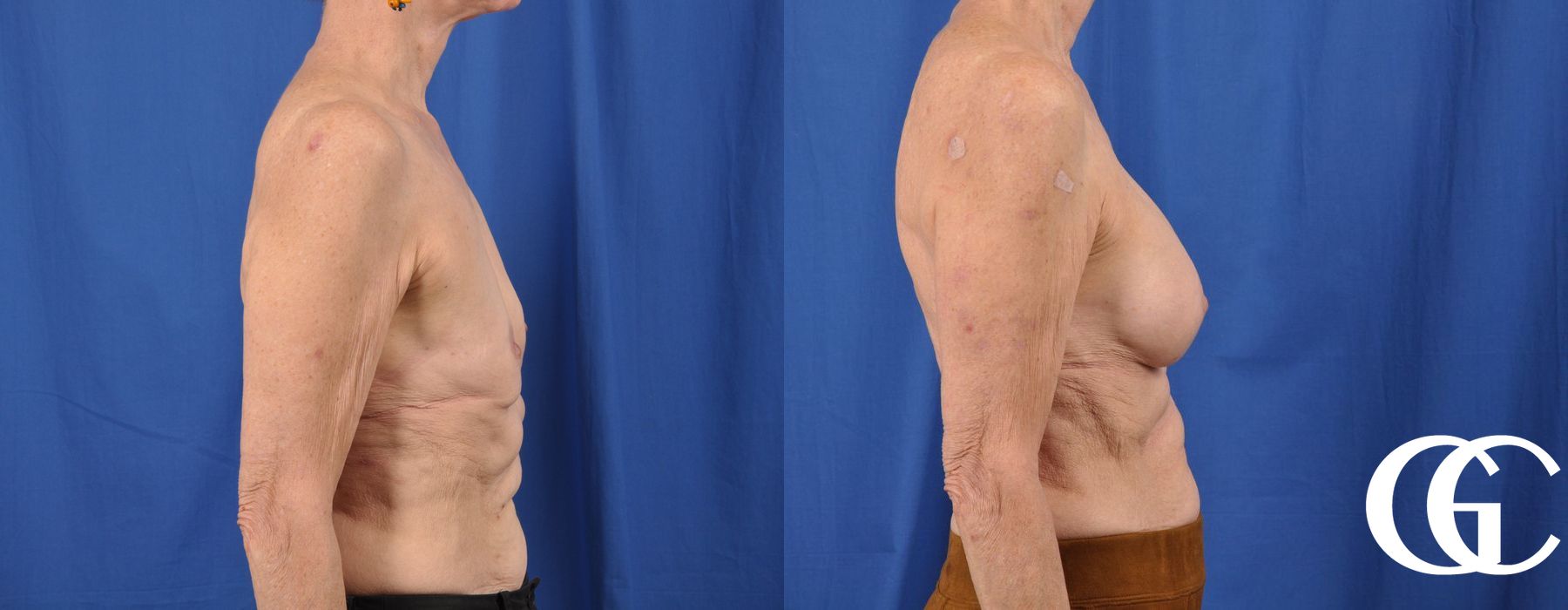 Breast Augmentation - Case 7174