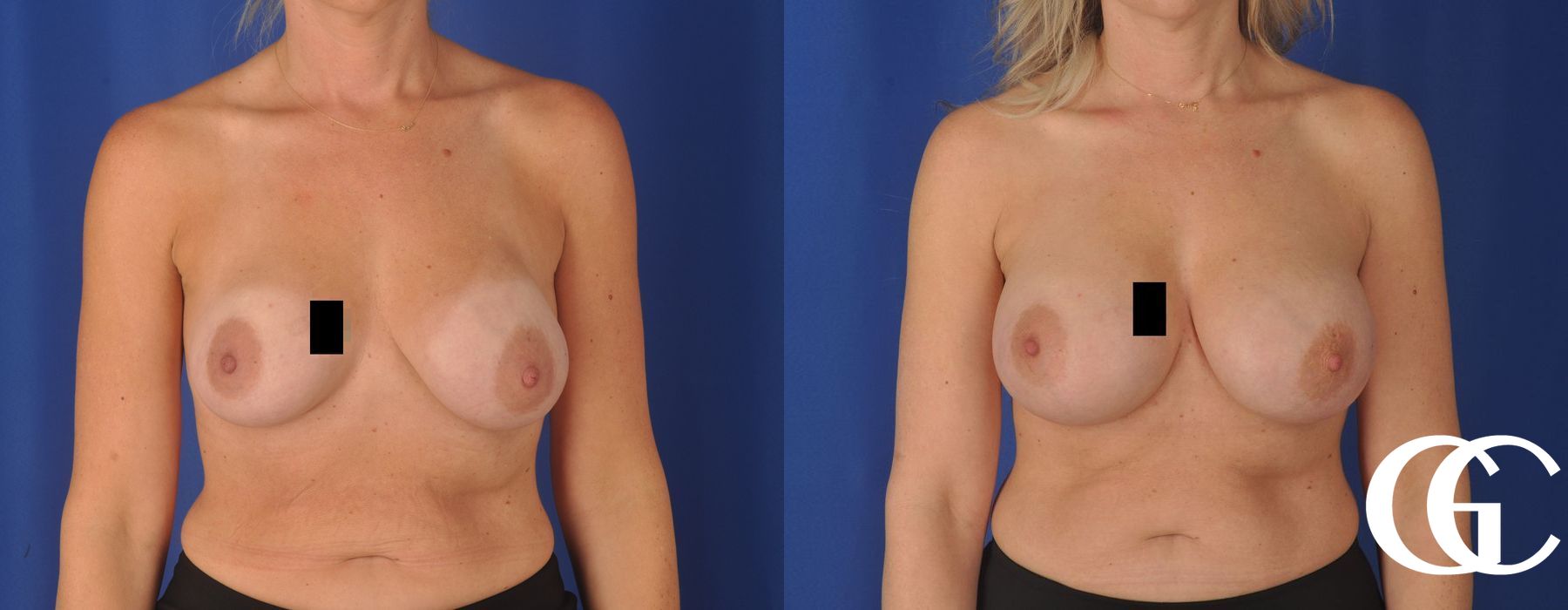 Breast Augmentation - Case 7169