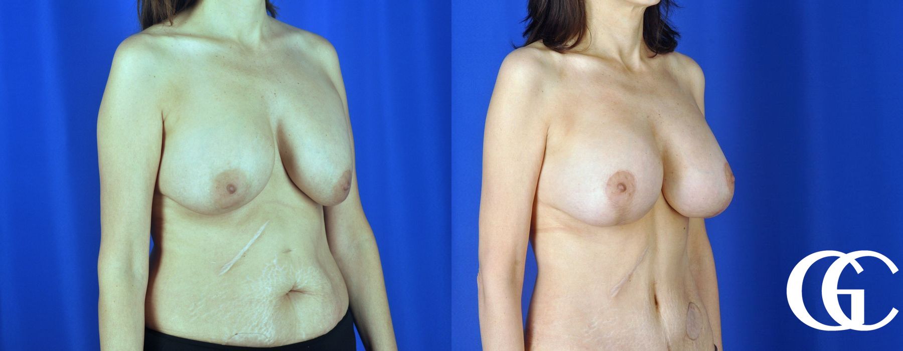 Breast Augmentation - Thumbnail 3