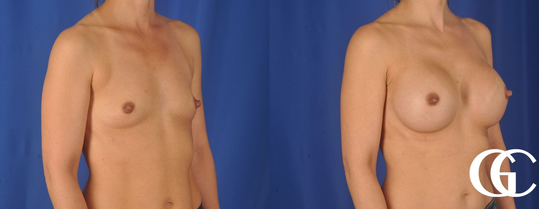 Breast Augmentation - Thumbnail 3