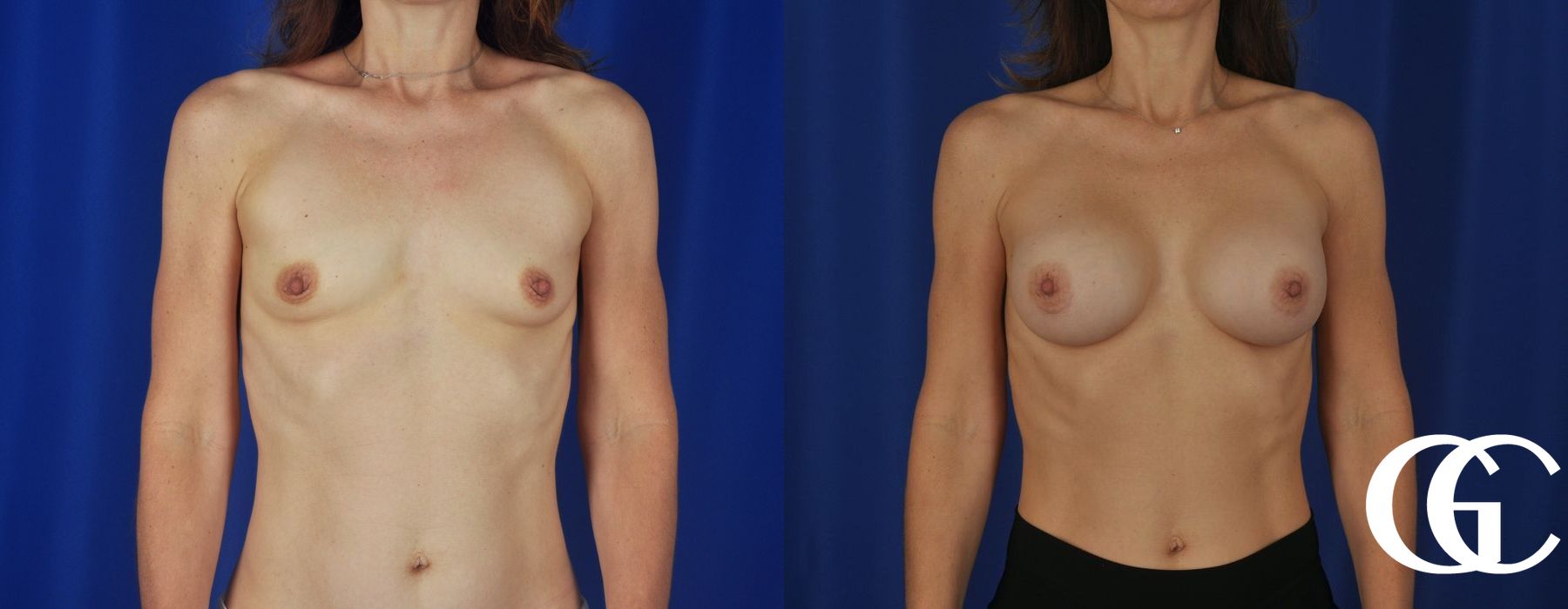 Breast Augmentation - Thumbnail 2