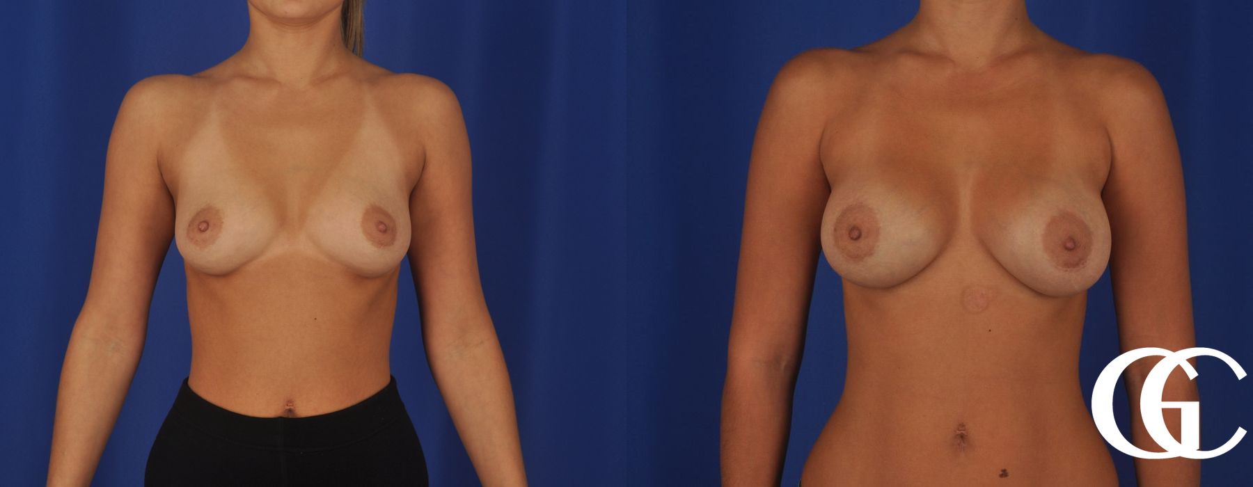 Breast Augmentation - Thumbnail 2