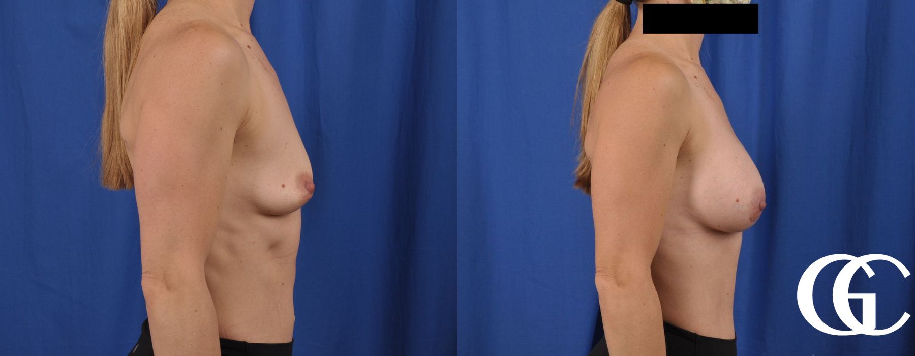 Breast Augmentation - Thumbnail 4