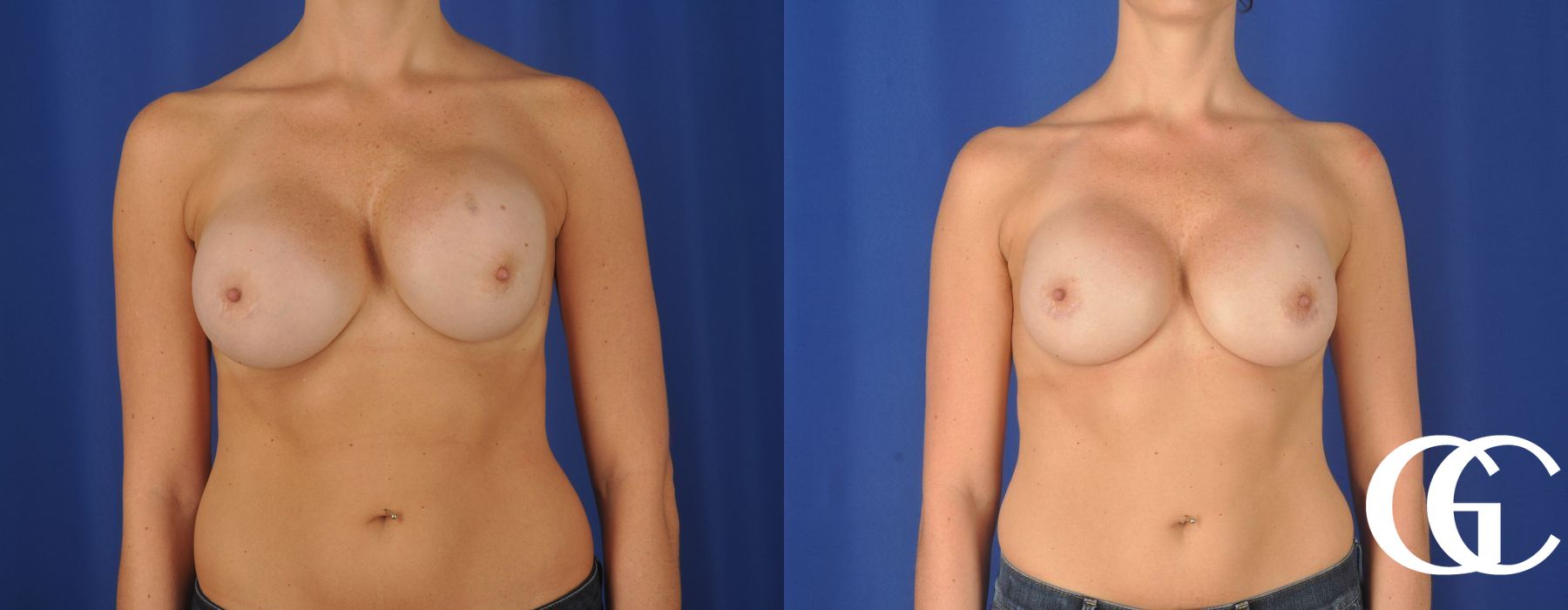 Breast Augmentation - Case 7166