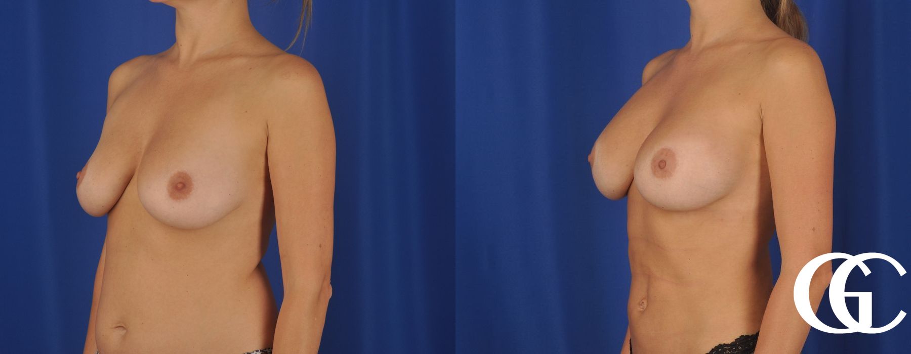 Breast Augmentation - Thumbnail 4