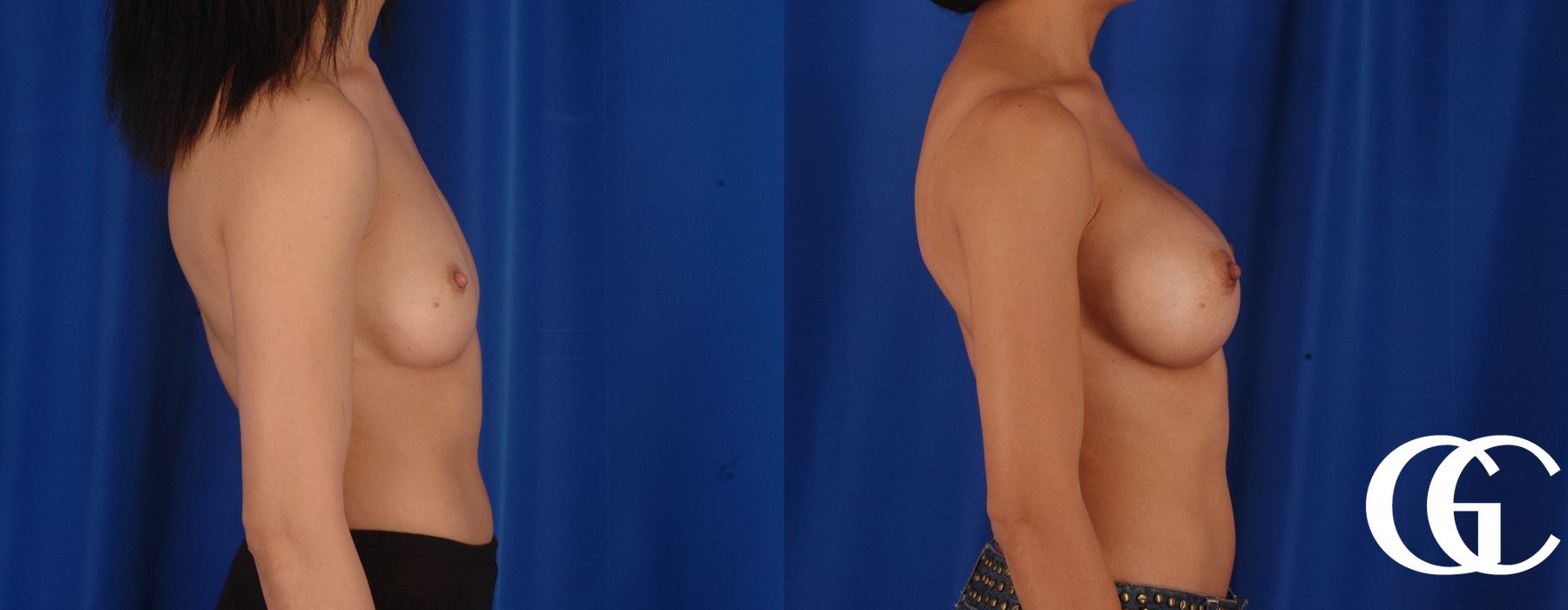 Breast Augmentation - Thumbnail 2