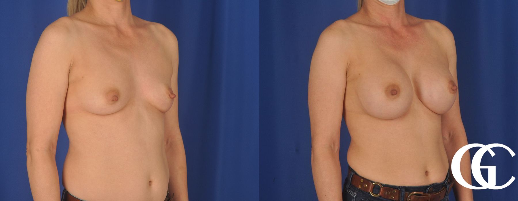 Breast Augmentation - Thumbnail 5