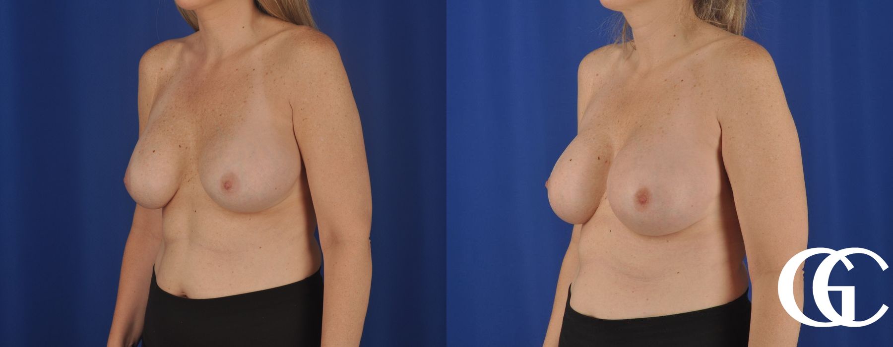Breast Augmentation - Thumbnail 4