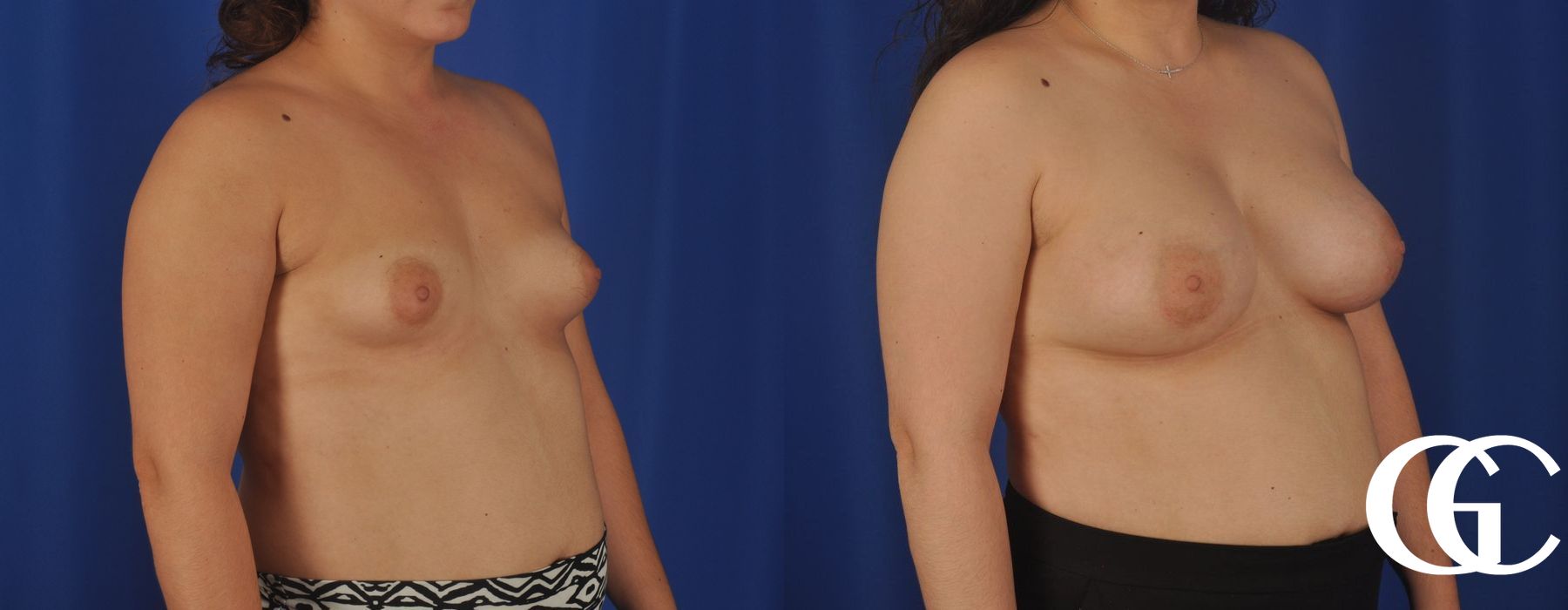 Breast Augmentation - Thumbnail 3