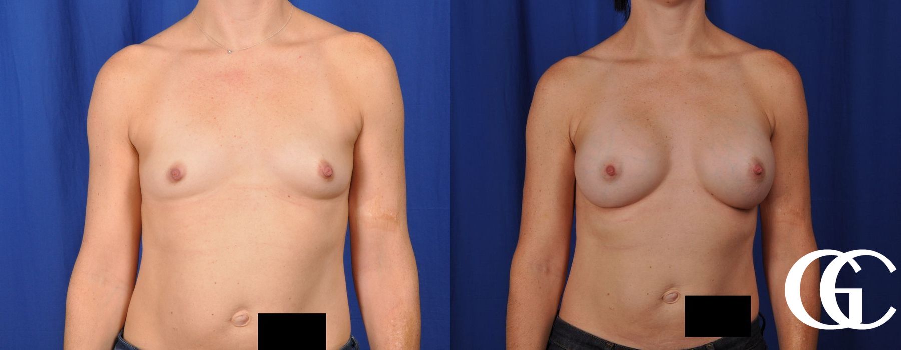 Breast Augmentation - Case 7126