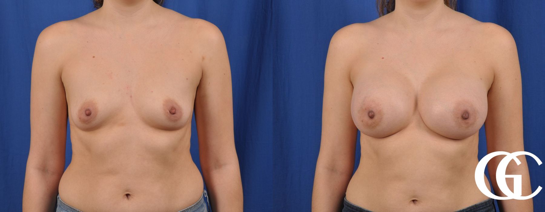 Breast Augmentation - Thumbnail 2