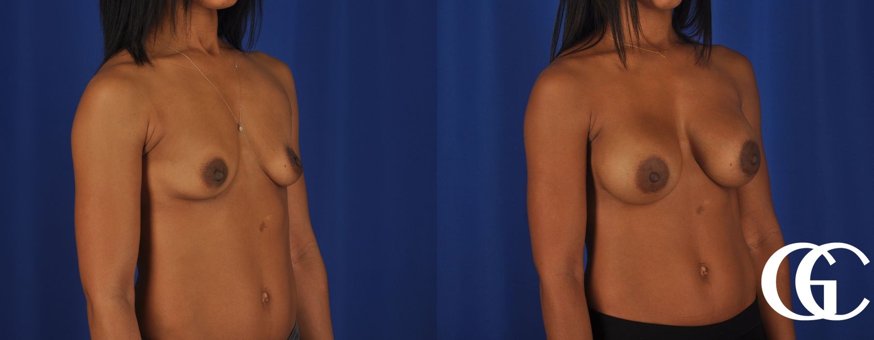 Breast Augmentation - Thumbnail 2