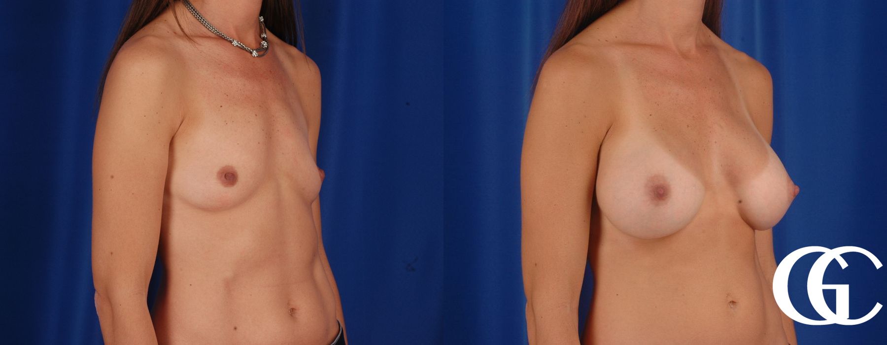 Breast Augmentation - Thumbnail 2