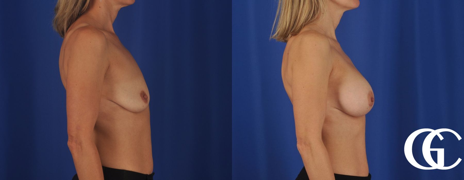 Breast Augmentation - Thumbnail 3