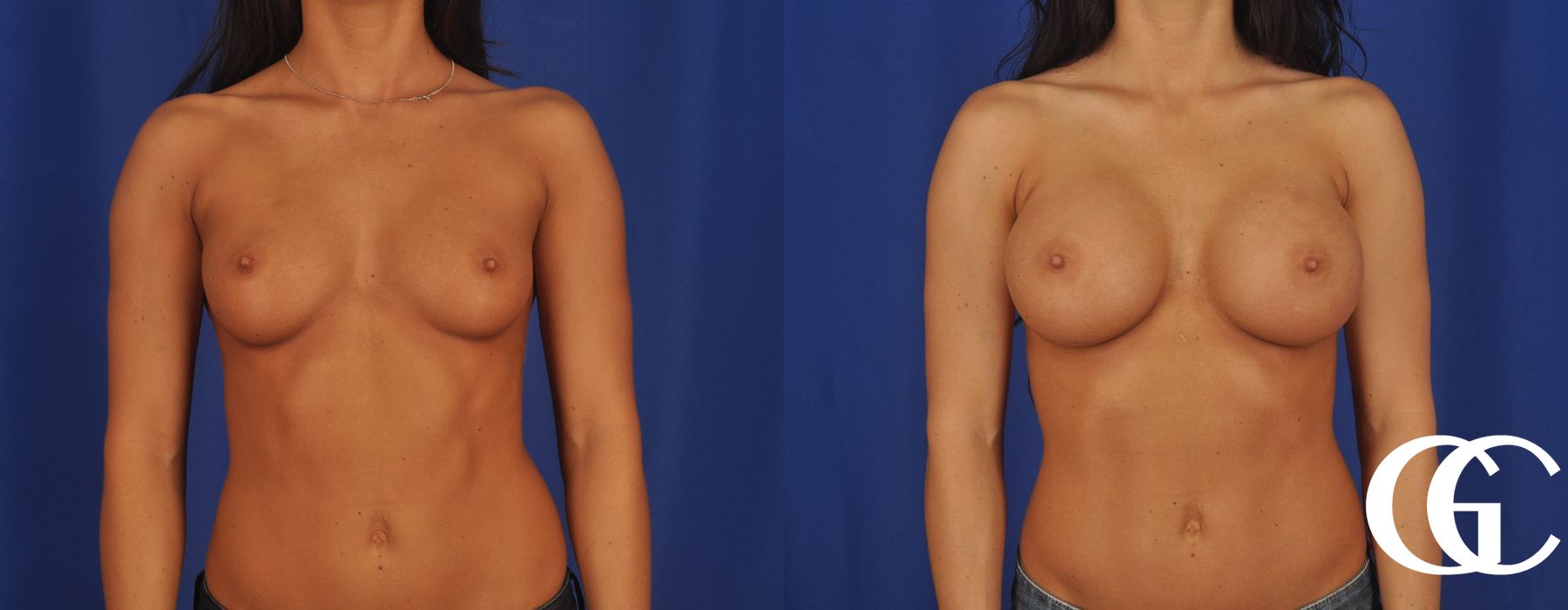 Breast Augmentation - Thumbnail 2