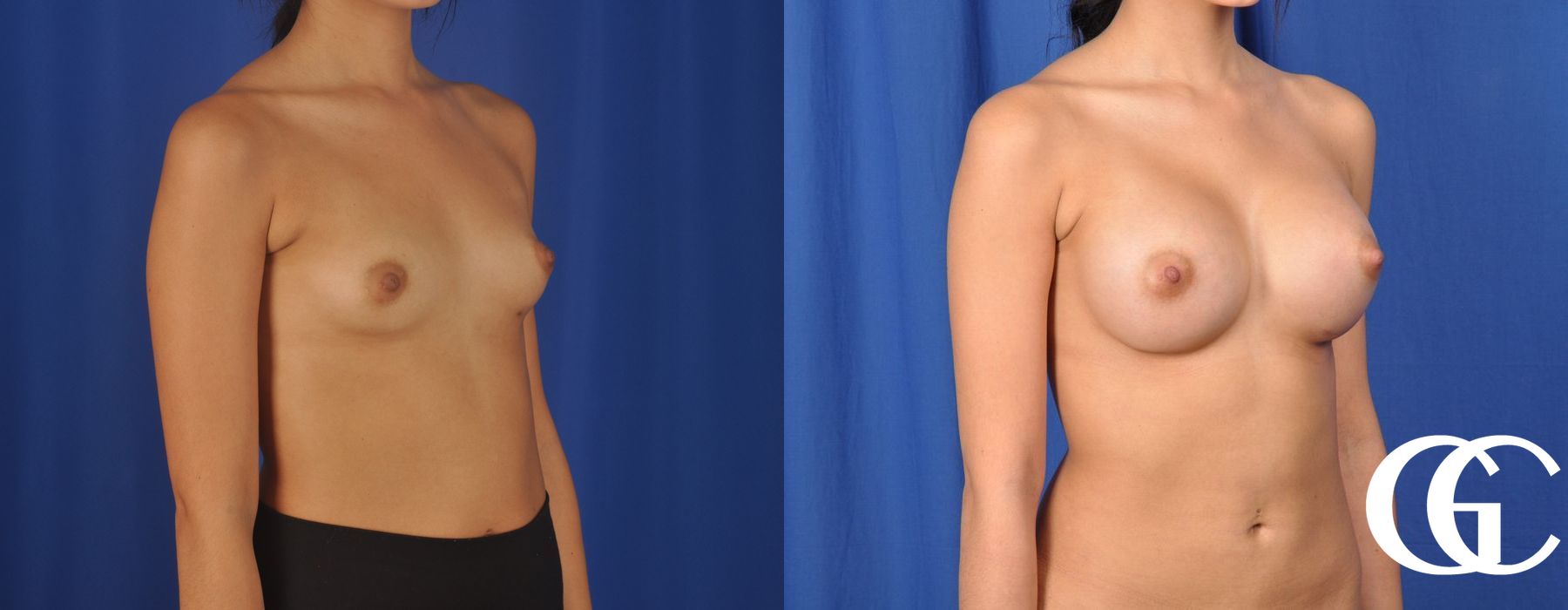 Breast Augmentation - Thumbnail 4