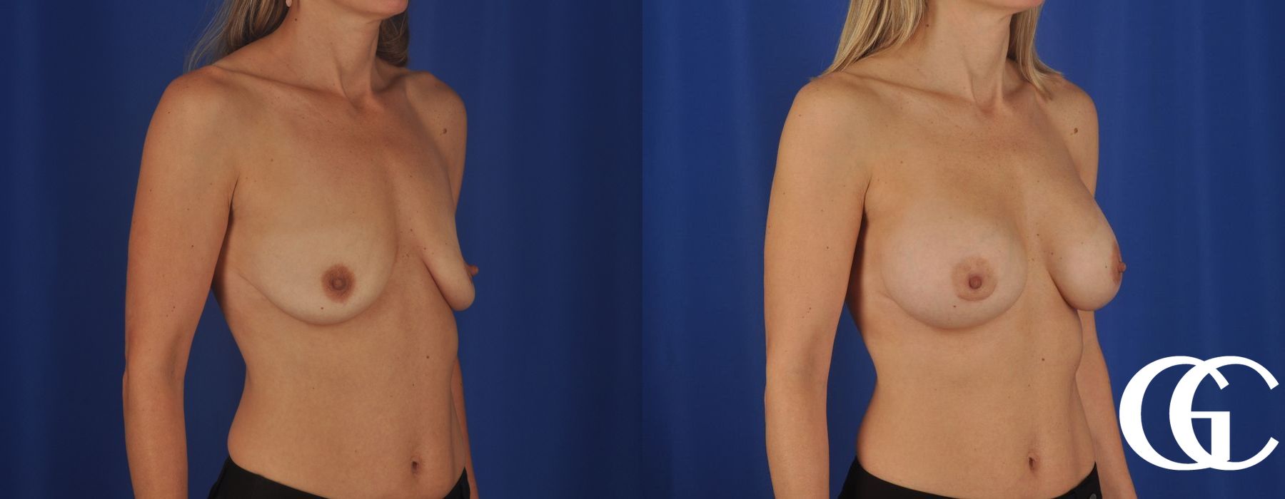 Breast Augmentation - Thumbnail 4