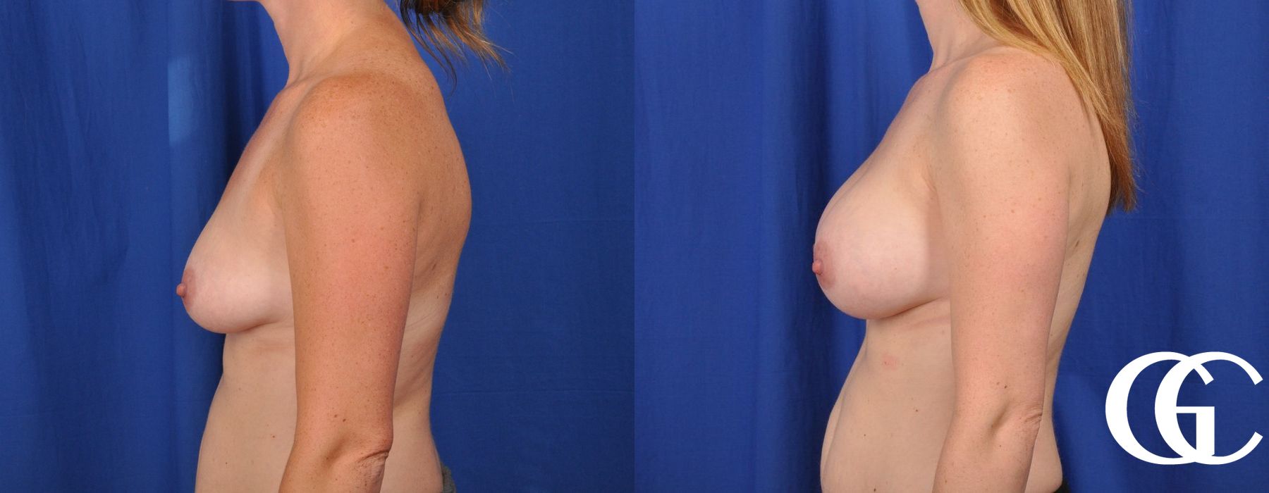 Breast Augmentation - Case 7100