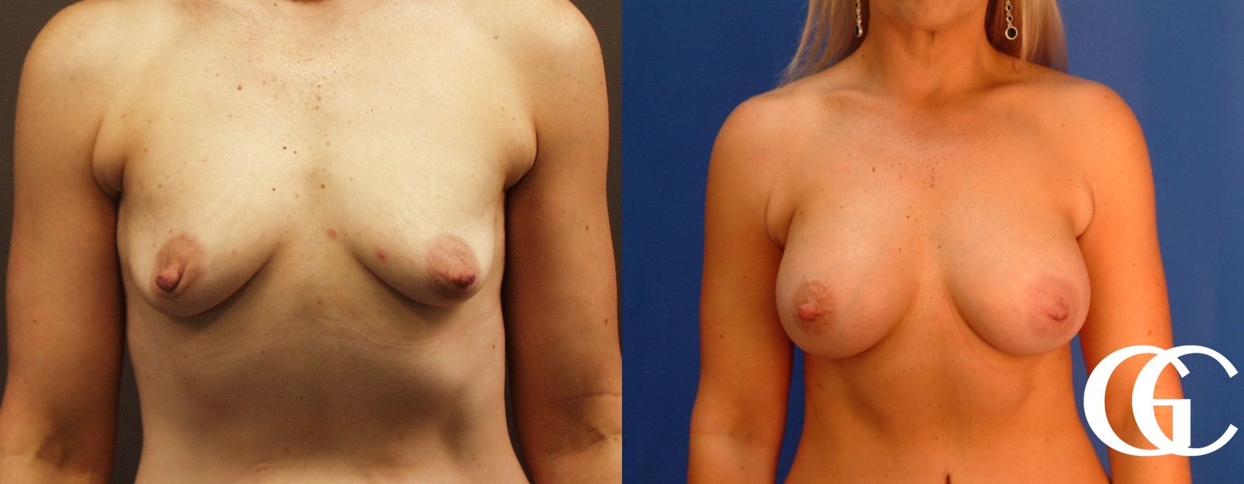 Breast Augmentation - Thumbnail 2