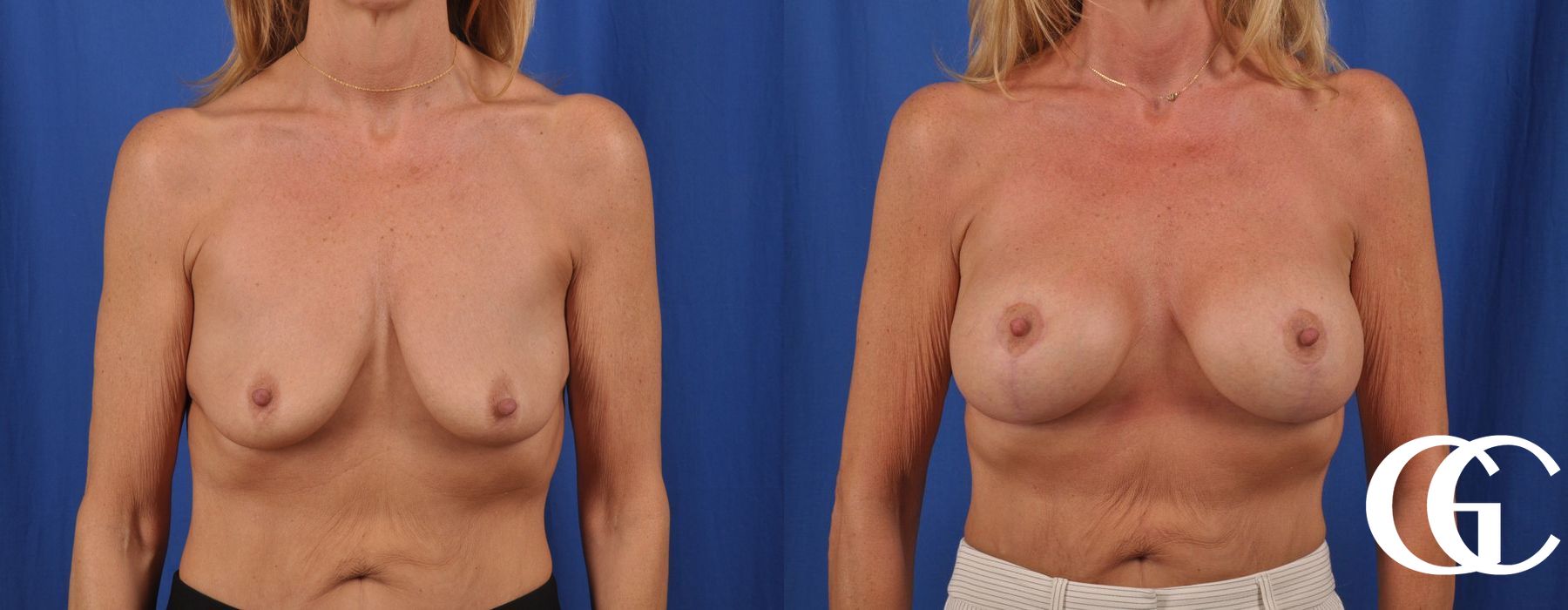 Breast Augmentation - Thumbnail 2