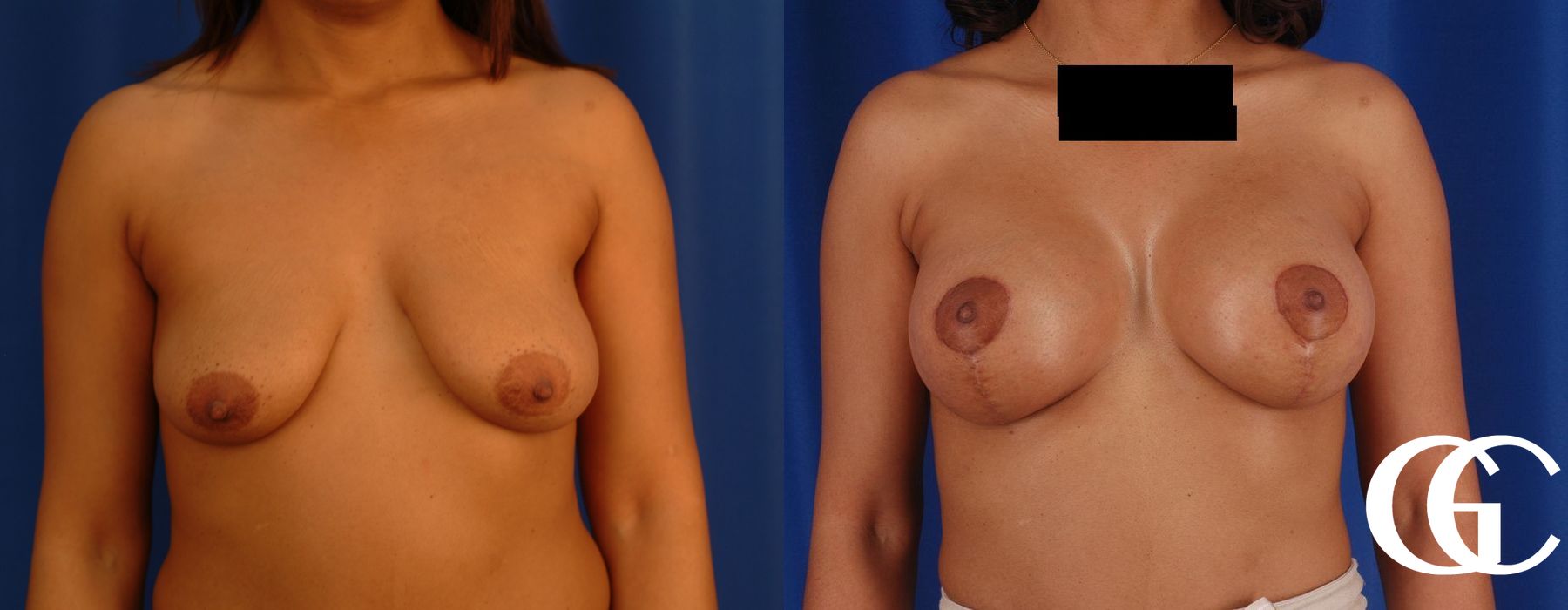 Breast Augmentation - Case 7219