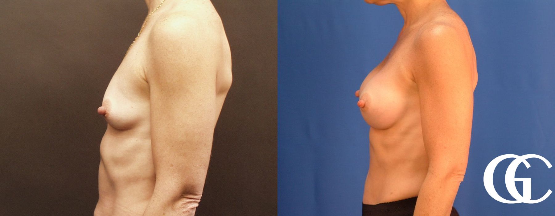 Breast Augmentation - Thumbnail 4