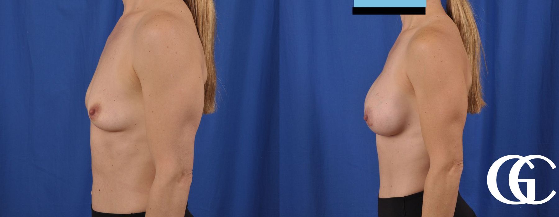 Breast Augmentation - Case 7230