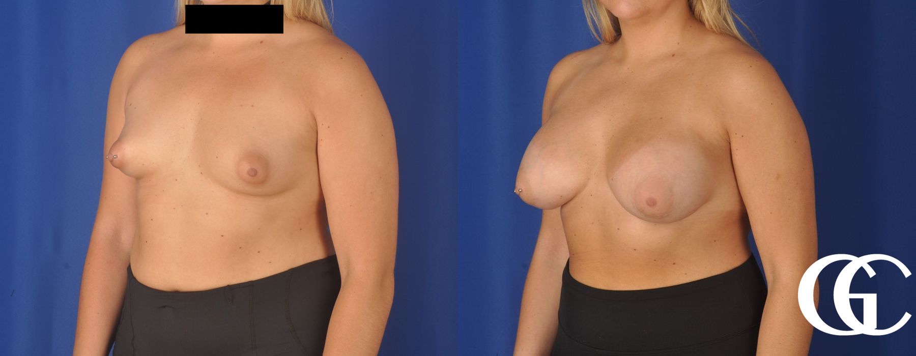 Breast Augmentation - Case 7215
