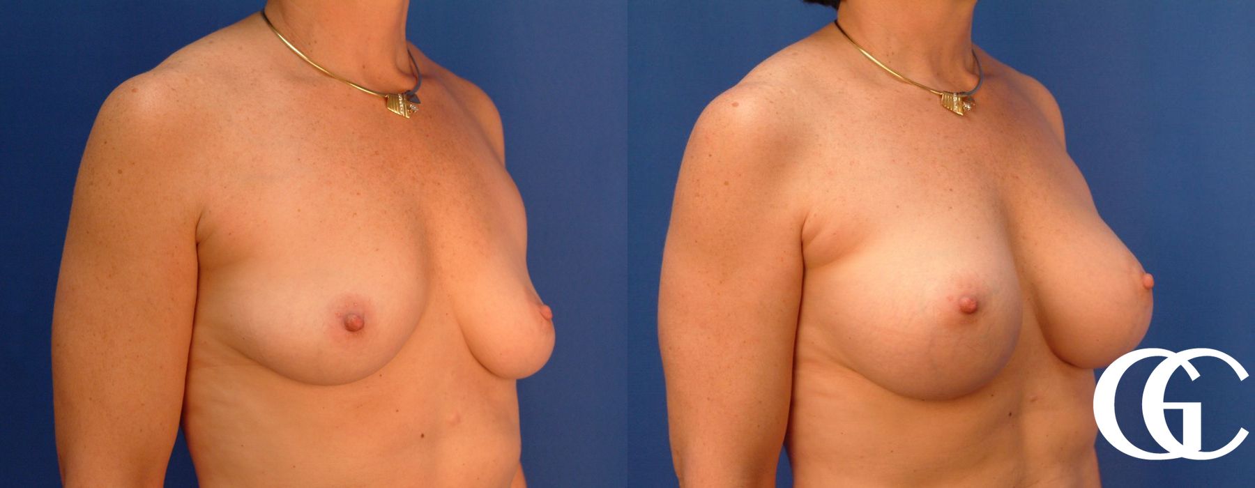 Breast Augmentation - Thumbnail 4