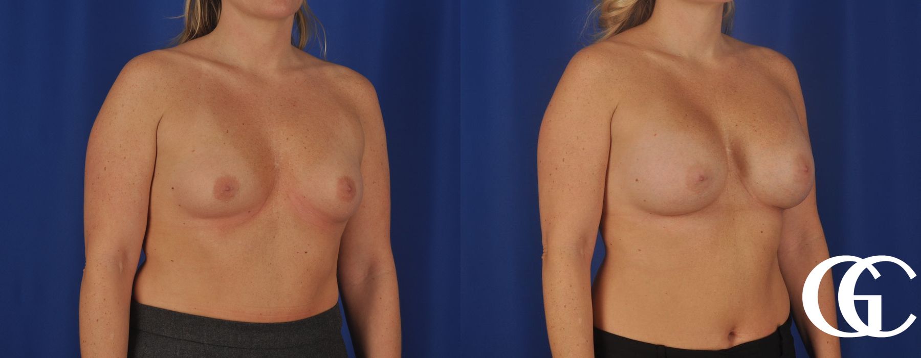 Breast Augmentation - Thumbnail 3