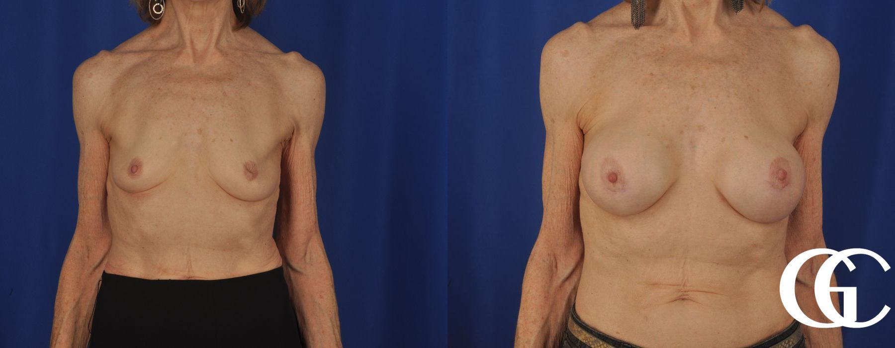Breast Augmentation - Case 7042