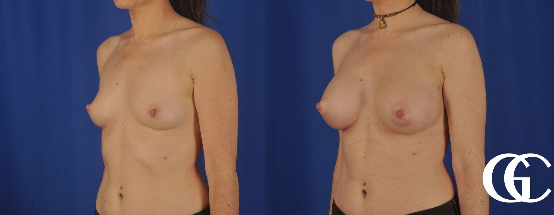 Breast Augmentation - Thumbnail 4