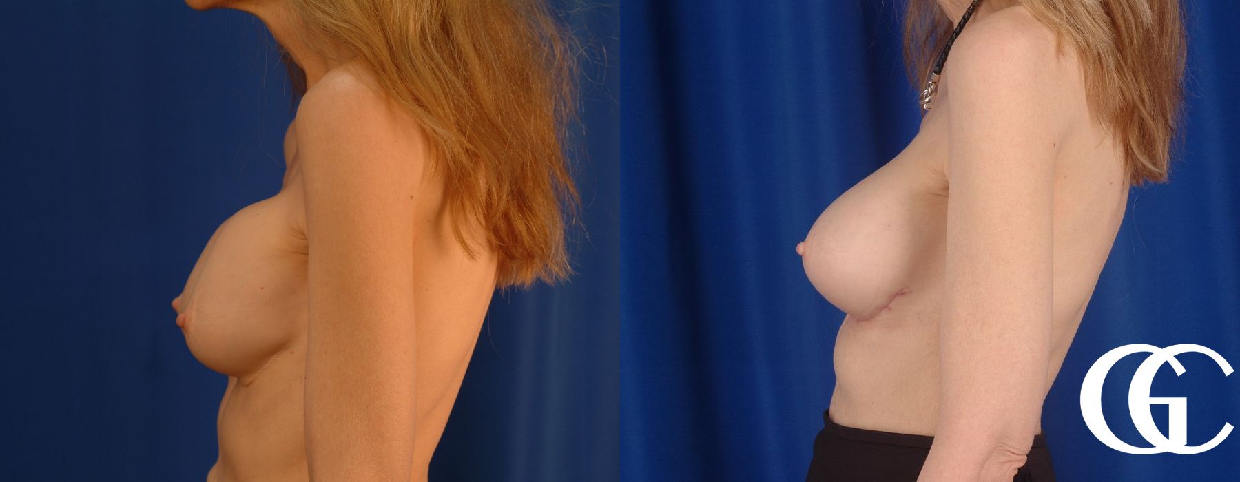 Breast Augmentation - Thumbnail 4