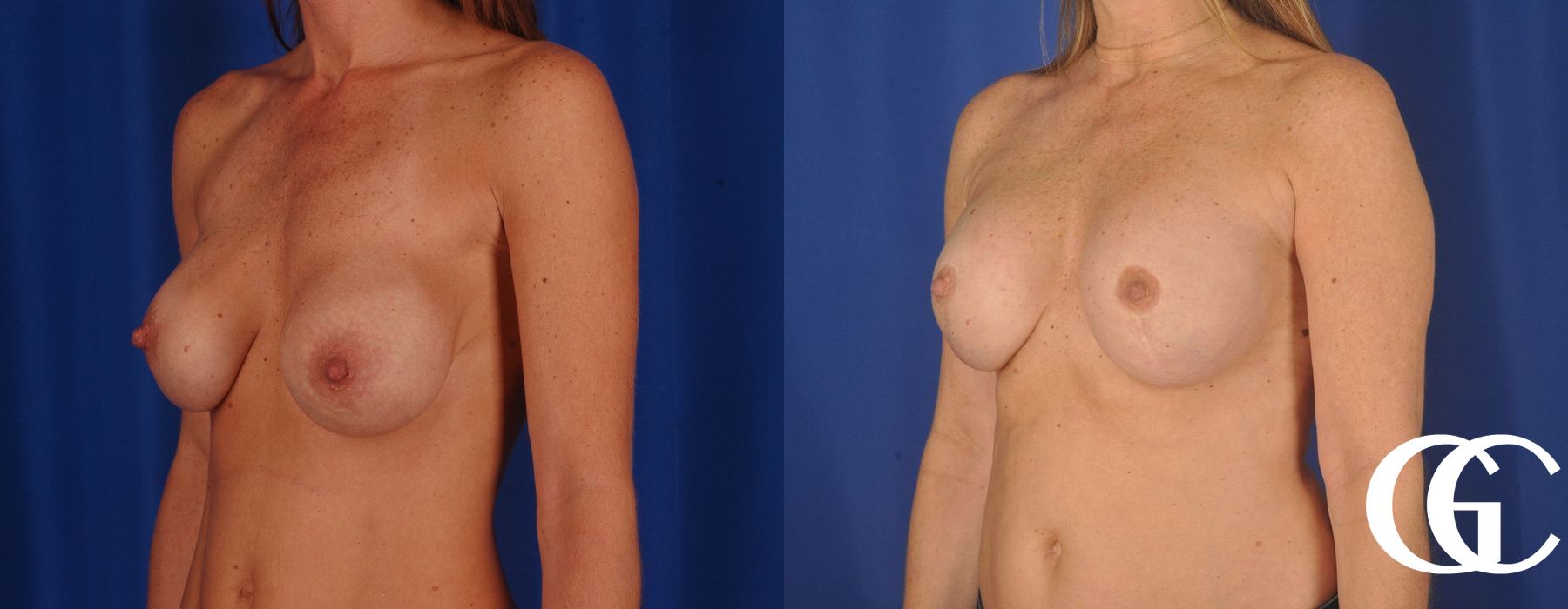 Breast Augmentation - Case 7194