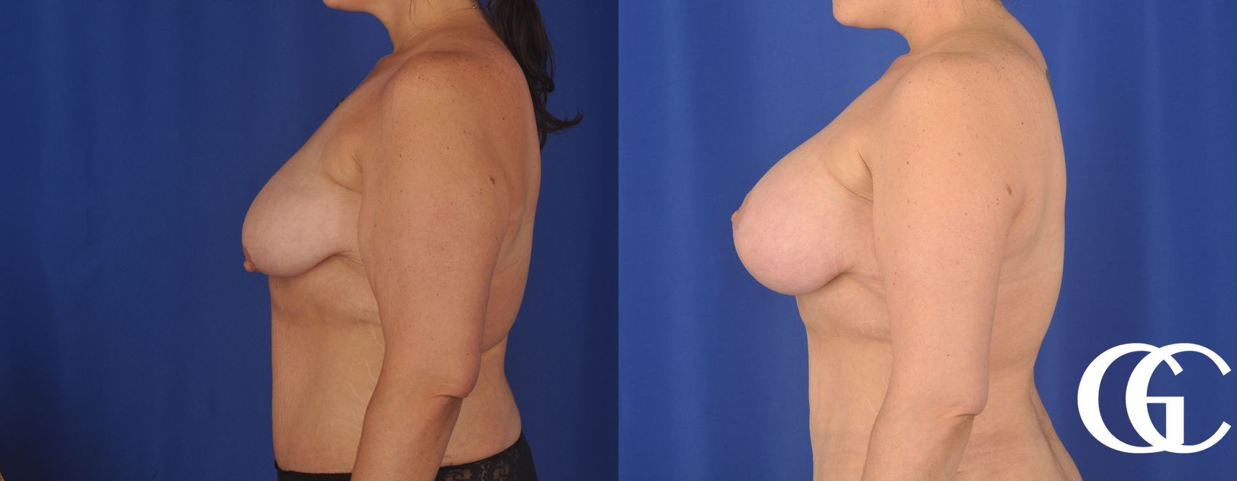 Breast Augmentation - Thumbnail 4